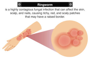 Homeopathic Medicine For Ringworm