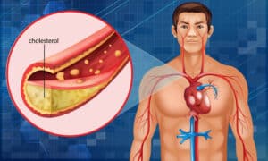 Homeopathic Medicine For High Cholesterol