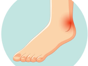 Homeopathic Medicines for Swollen Ankles