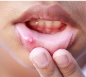 Homeopathic Medicines For Mouth Ulcer