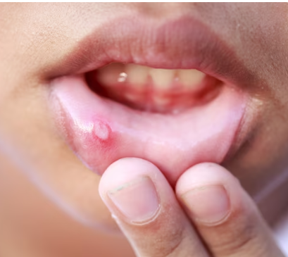 Homeopathic Medicines For Mouth Ulcer