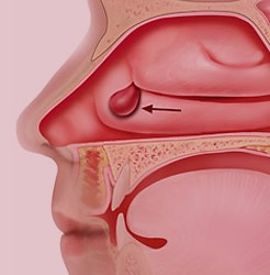 Homeopathic Medicine for Nasal Polyps