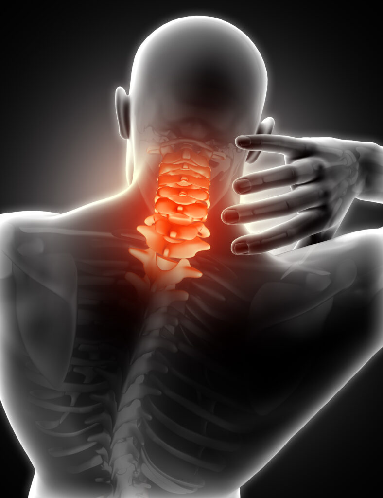 Best Homeopathic Medicine For Cervical Spondylosis