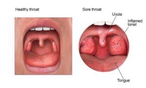 homeopathic medicine for Tonsillitis