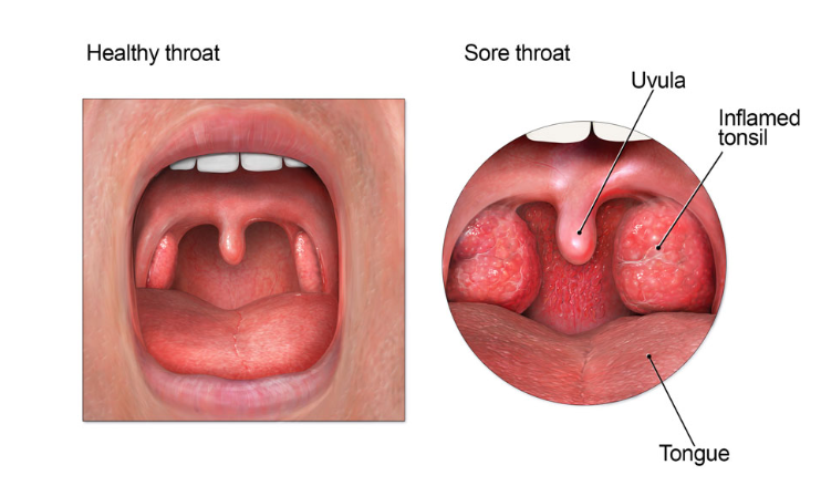 homeopathic medicine for Tonsillitis