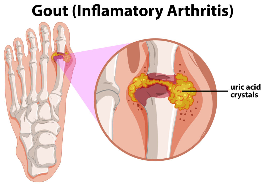 Homeopathic Medicine For Uric Acid