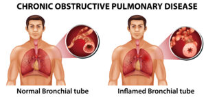 Homeopathic Medicine For Bronchitis