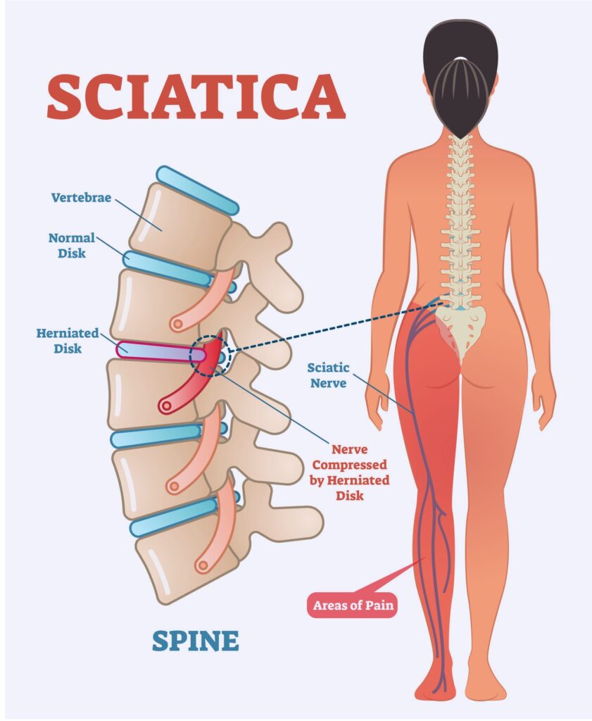 Best Homeopathic Medicine For Sciatica