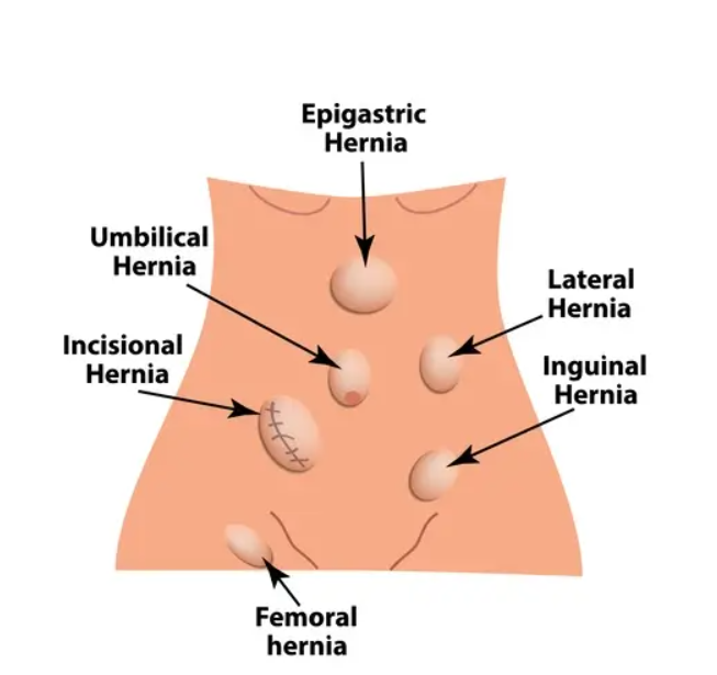 Homeopathic Medicine For Hernia
