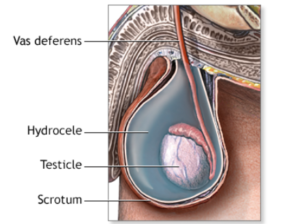 Homeopathic Medicine For Hydrocele