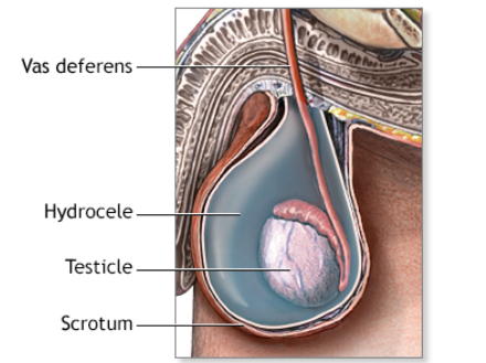 Homeopathic Medicine For Hydrocele 