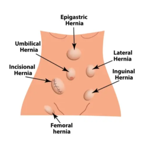 Homeopathic Medicine For Hernia