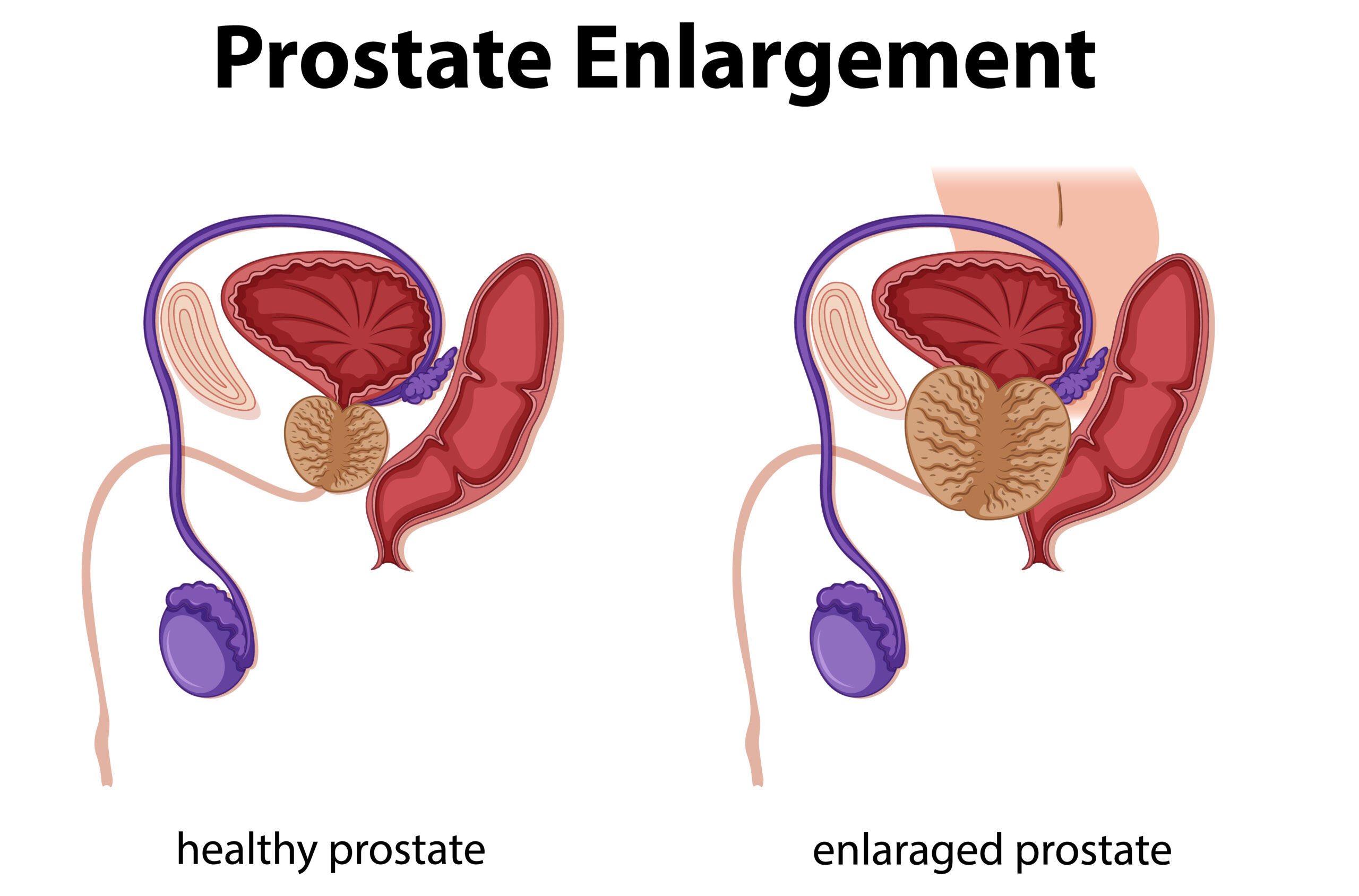 Homeopathic Medicine For Prostate Enlargement