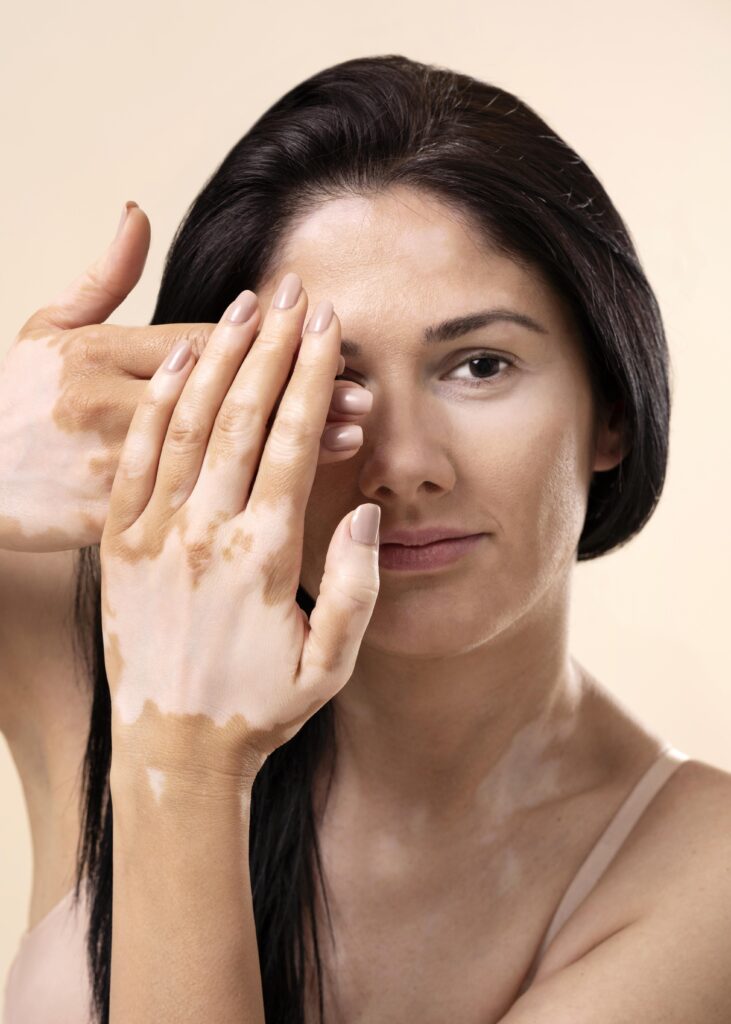 Homeopathic Medicine For Leucoderma